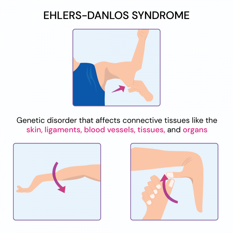 Síndrome de Ehler danlos